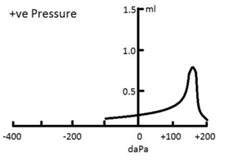 positive middle ear pressure tympanogram.